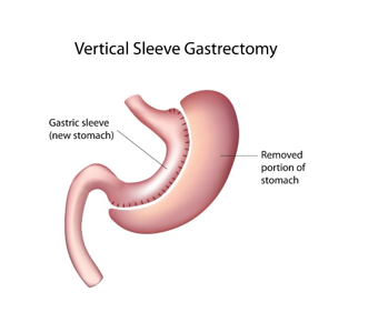 Gastrectomia Vertical (ou sleeve)
